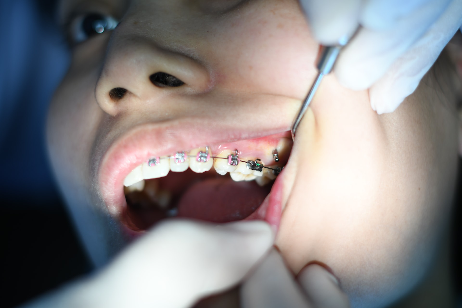 Are Braces Painful? 7 Things You Need to Know