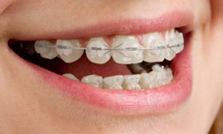 Freehold Orthodontics Ceramic braces