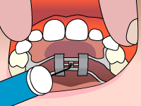 Freehold Orthodontics Palatal Expander Step2