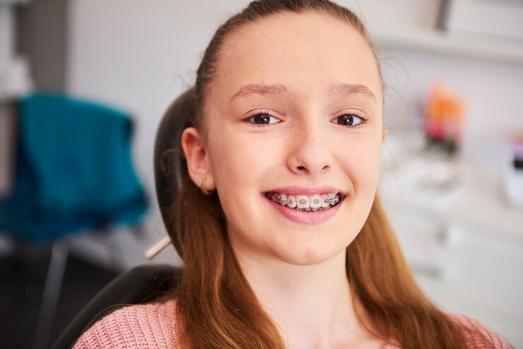 Clear orthodontic braces