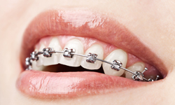 Freehold Orthodontics Self-ligating braces